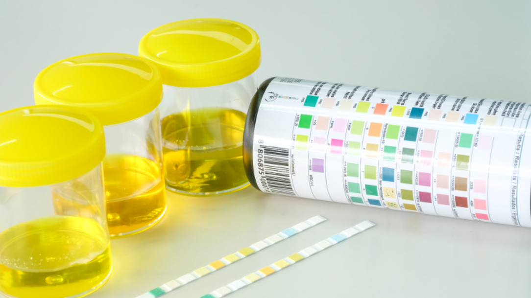 소변 색깔이 갈색일 때, 신호하는 질환