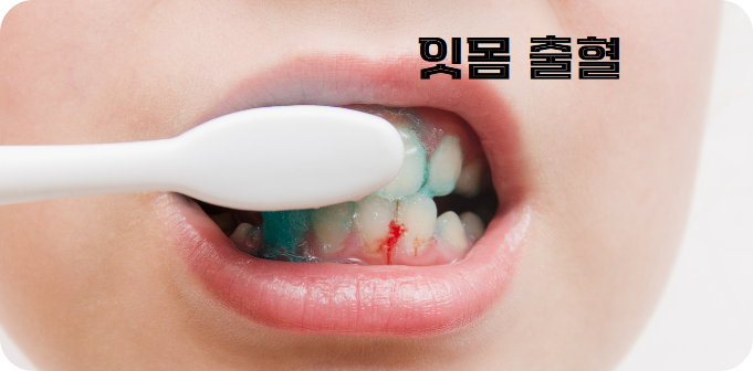 비타민 K 결핍 증상, 잇몸 출혈