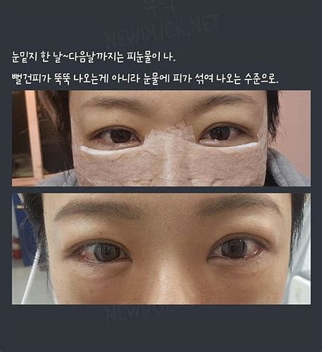 눈밑레이저