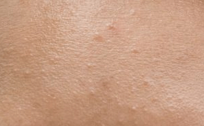 좁쌀 여드름 사진