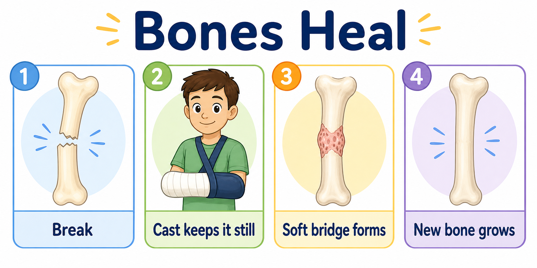 Infographic explaining broken bone, cast, soft bridge, and new strong bone
