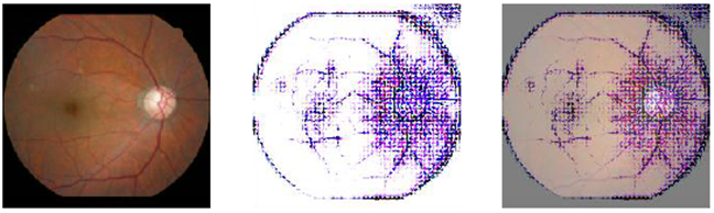 눈 검사로 심혈관질환 위험 예측하기
