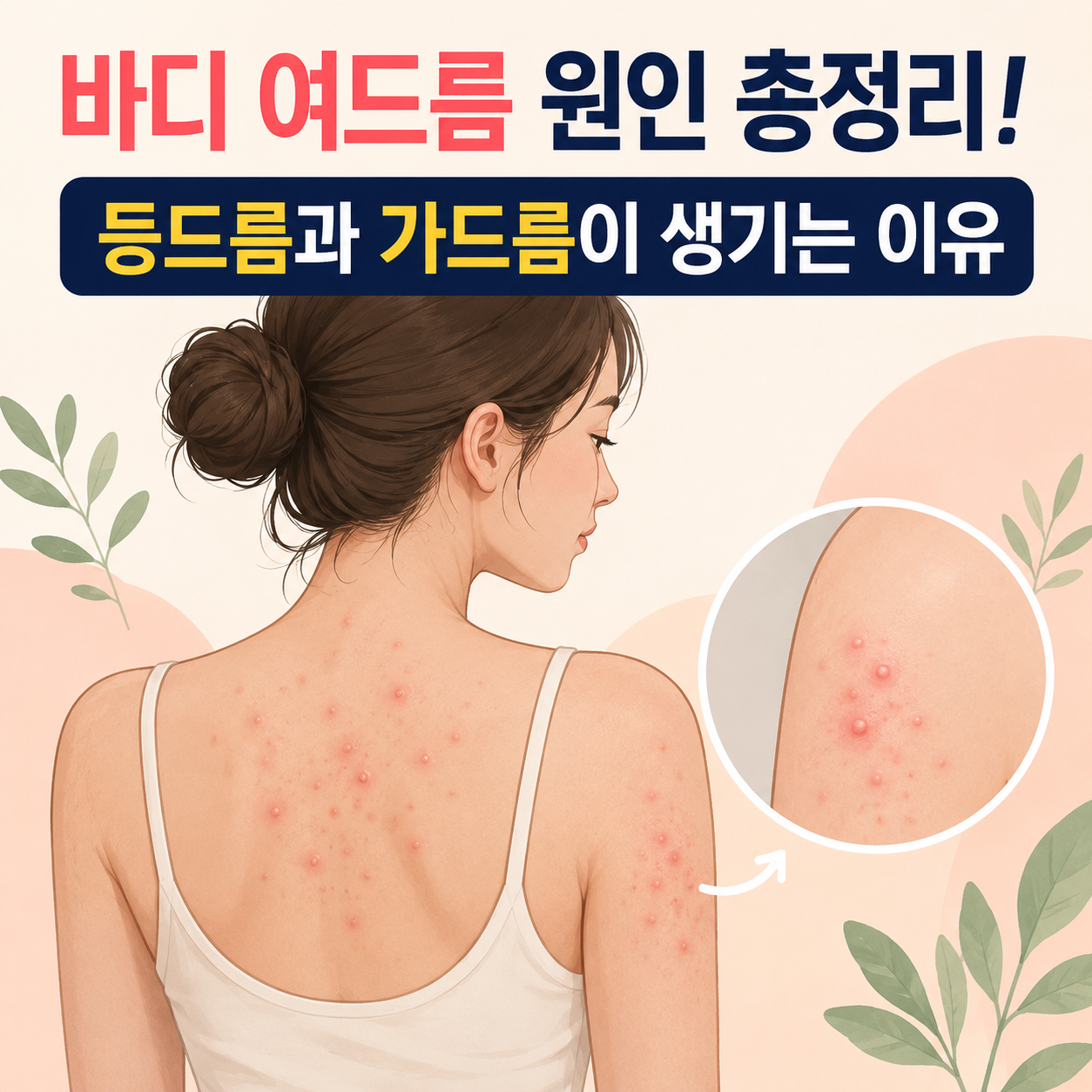 바디 여드름 원인