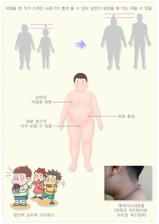 소아비만 추가적인 증상