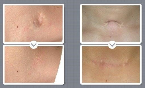 상처 쉬운 치료 방법과 관리: 수술 상처, 다친 상처, 흉터 관리.