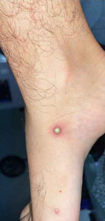 원숭이두창 증상