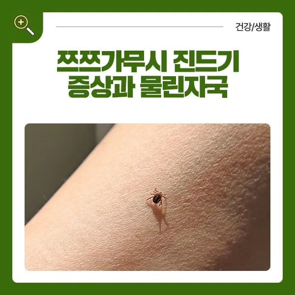 진드기 물린자국 대처법 참진드기 빨간 진드기 증상 확인_8