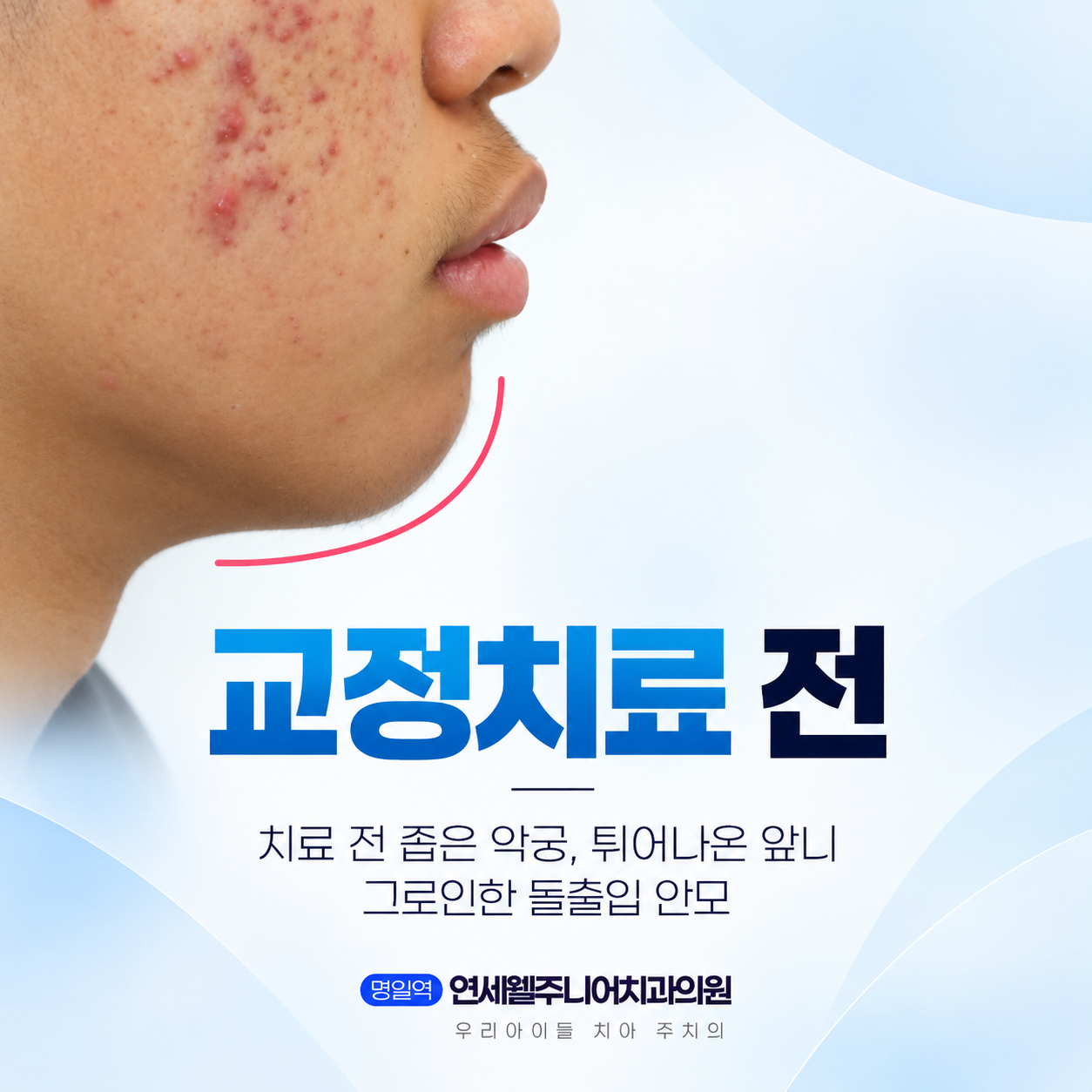 중학생 돌출입 교정 전 앞으로 돌출된 입술과 턱의 측면 모습 및 안모 상태