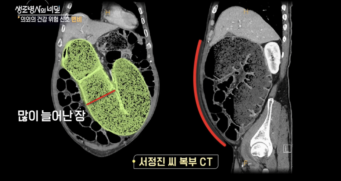 생로병사의 비밀, 변비, 몸이 보내는 위험신호