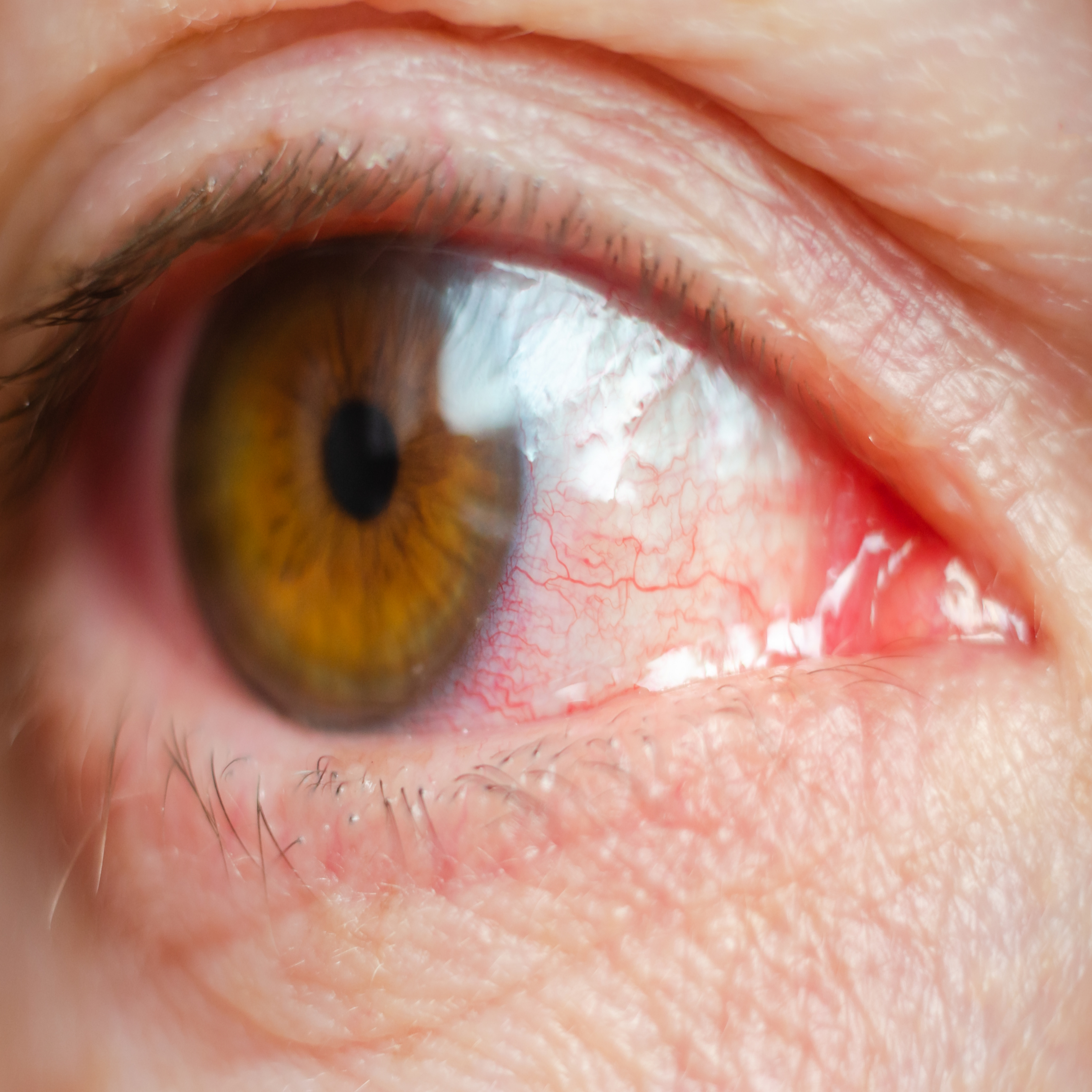 40대 이상 필독, 녹내장 조기 발견법