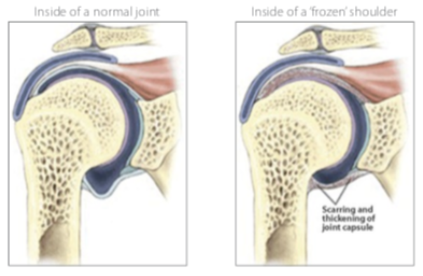 유착성 관절막염