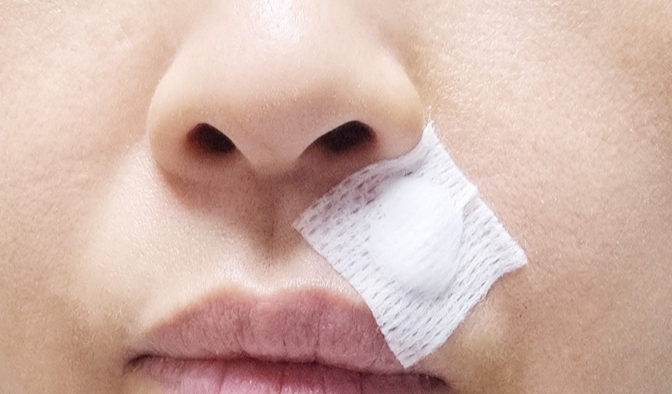 얼굴 피지낭종 제거 후기