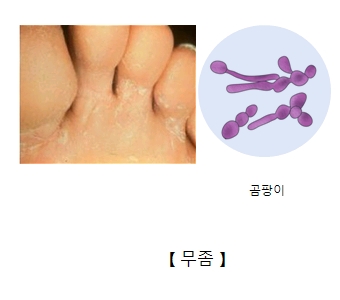 무좀 곰팡이균 이미지