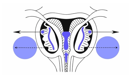 자궁내막증 원인과 의심증상