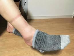 종아리 근육 통증 원인