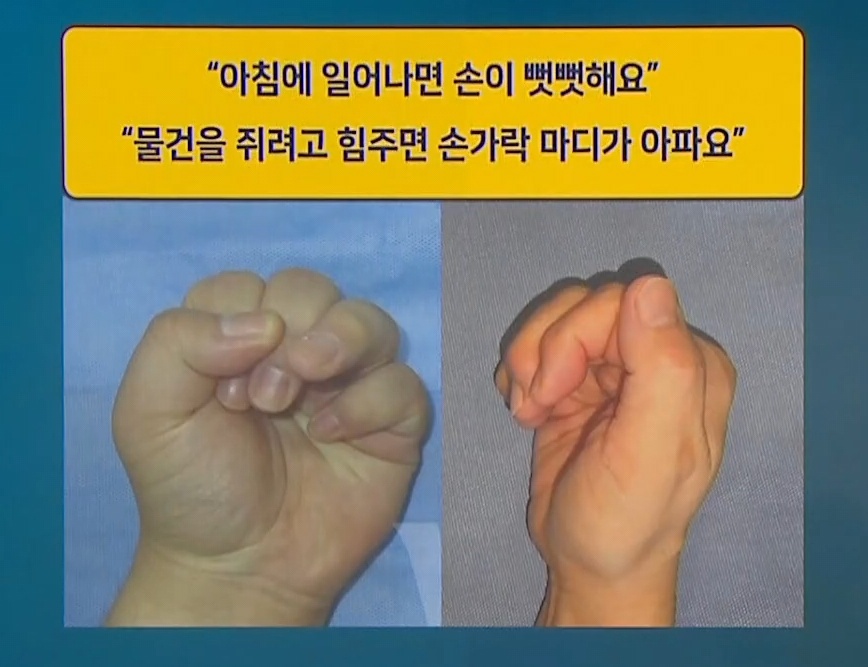 EBS명의-손목-명의-이재성-교수-