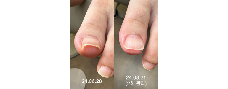 시흥시 내성발톱