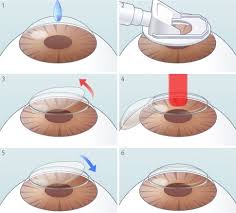 라식과 라섹 차이점