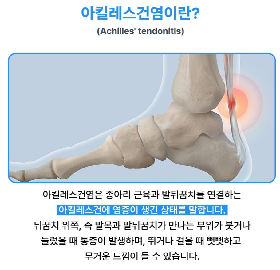 족저근막염 증상 아침 발뒤꿈치 통증