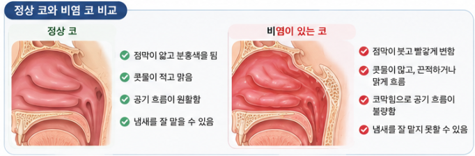 정상인 코와 비염이 있는 코 비교