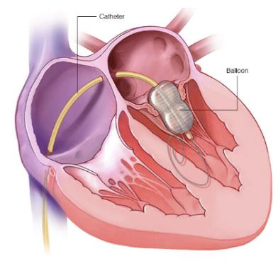 심장판막증 수술 비용