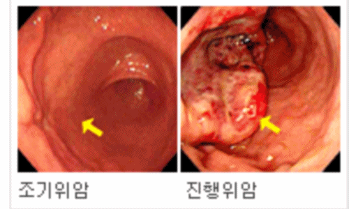 위암 이미지