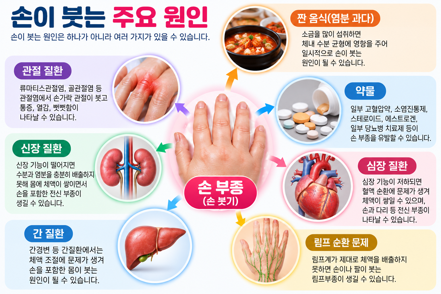 염분, 약물, 관절 및 전신 질환 등 손 부종의 가능한 원인 그림