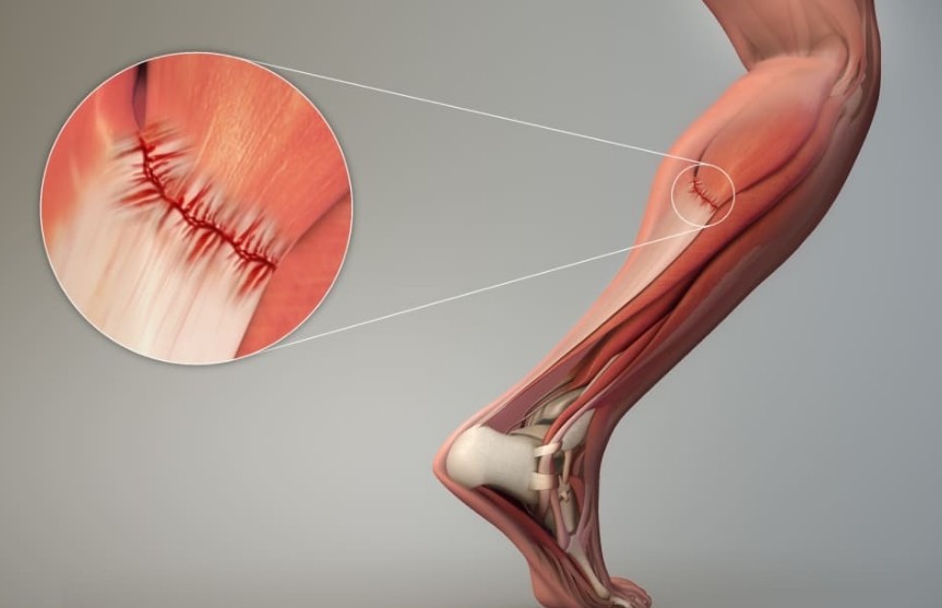 종아리-근육파열-증상