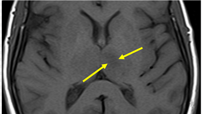  뇌경색 전조증상 확인법과 FAST 자가진단 및 골든타임 예방 관리 가이드