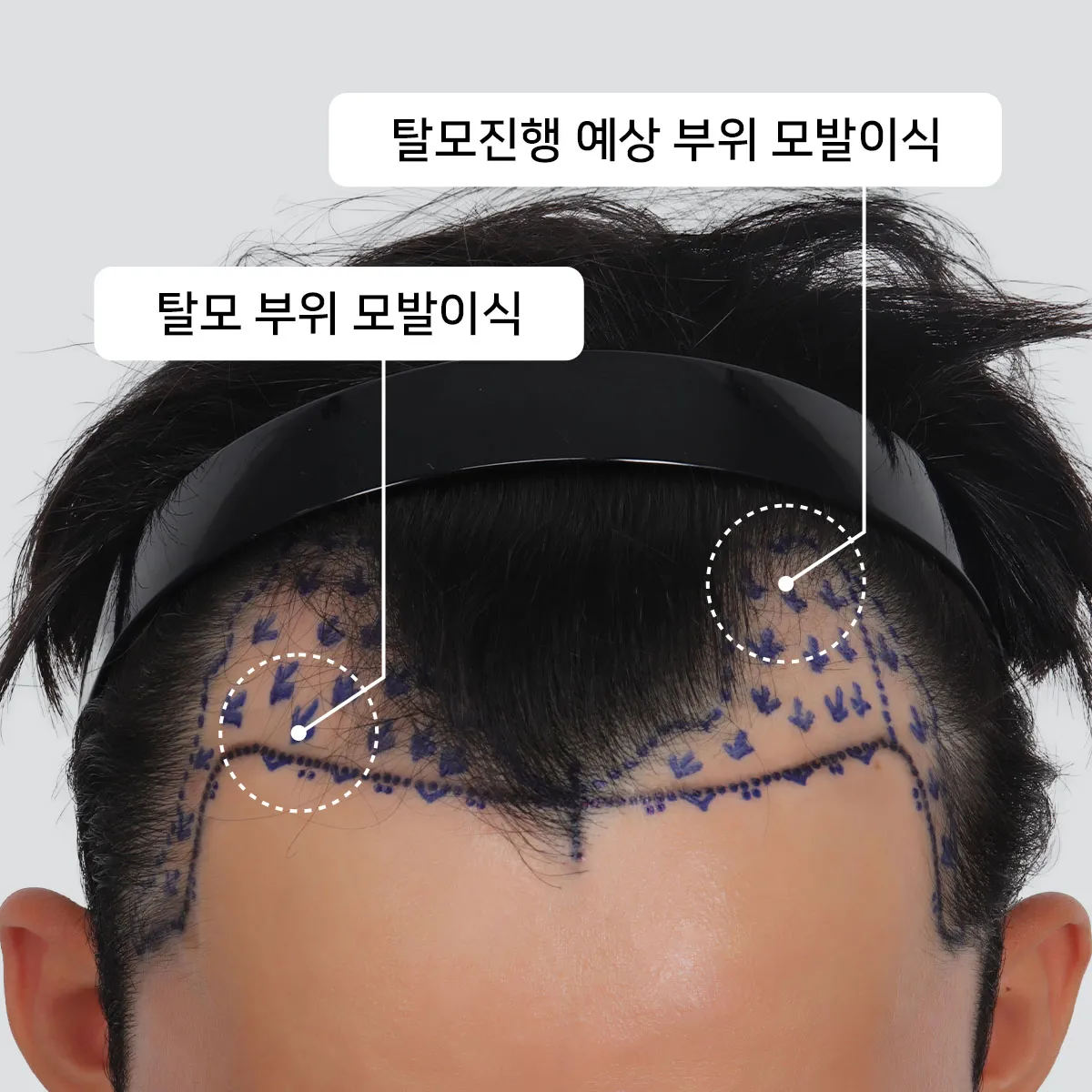 머리카락 이식 3000모 3000모낭 비용과 시술 과정_4