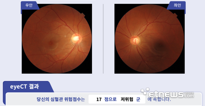 닥터눈 CVD의 원리
