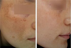 기미 크림 추천