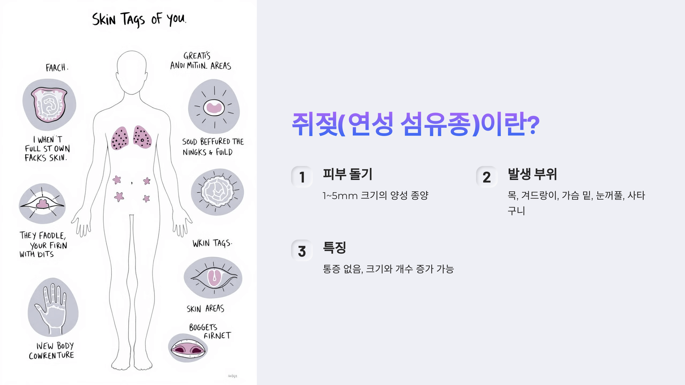 쥐젖과 관련된 사진입니다.