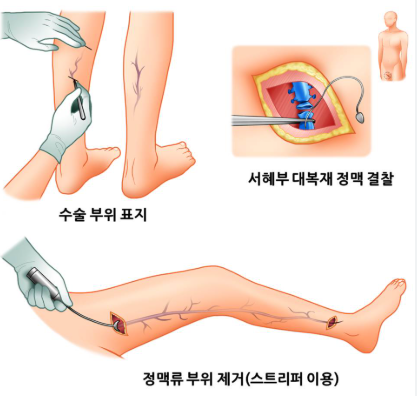하지정맥류