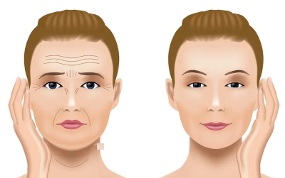 팔자주름 없애기 그리고 없애는 운동 9