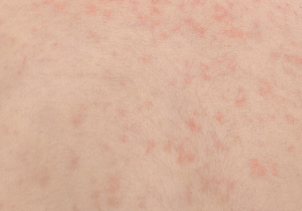 아토피 습진과 알러지가 너무 심할 때 에보프림 연질캡슐 처방 받아 먹더라고요. 근데 어떻게 먹는지 아세요?