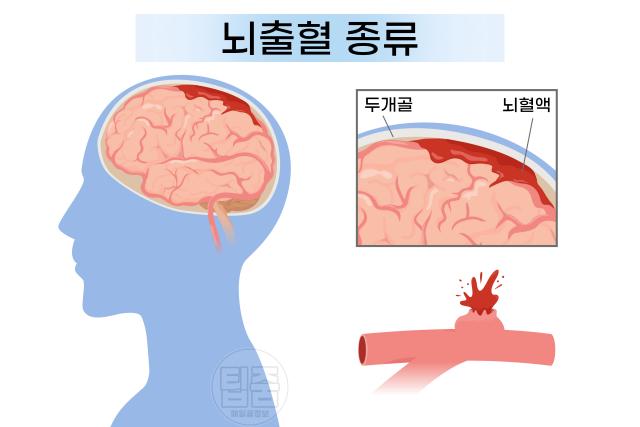 뇌혈관 터짐 위치 뇌출혈 종류
