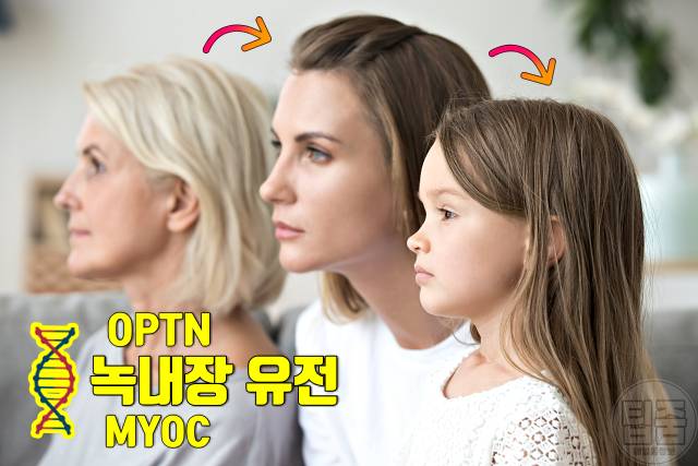 녹내장 원인 녹내장 실명확률 가족력 유전