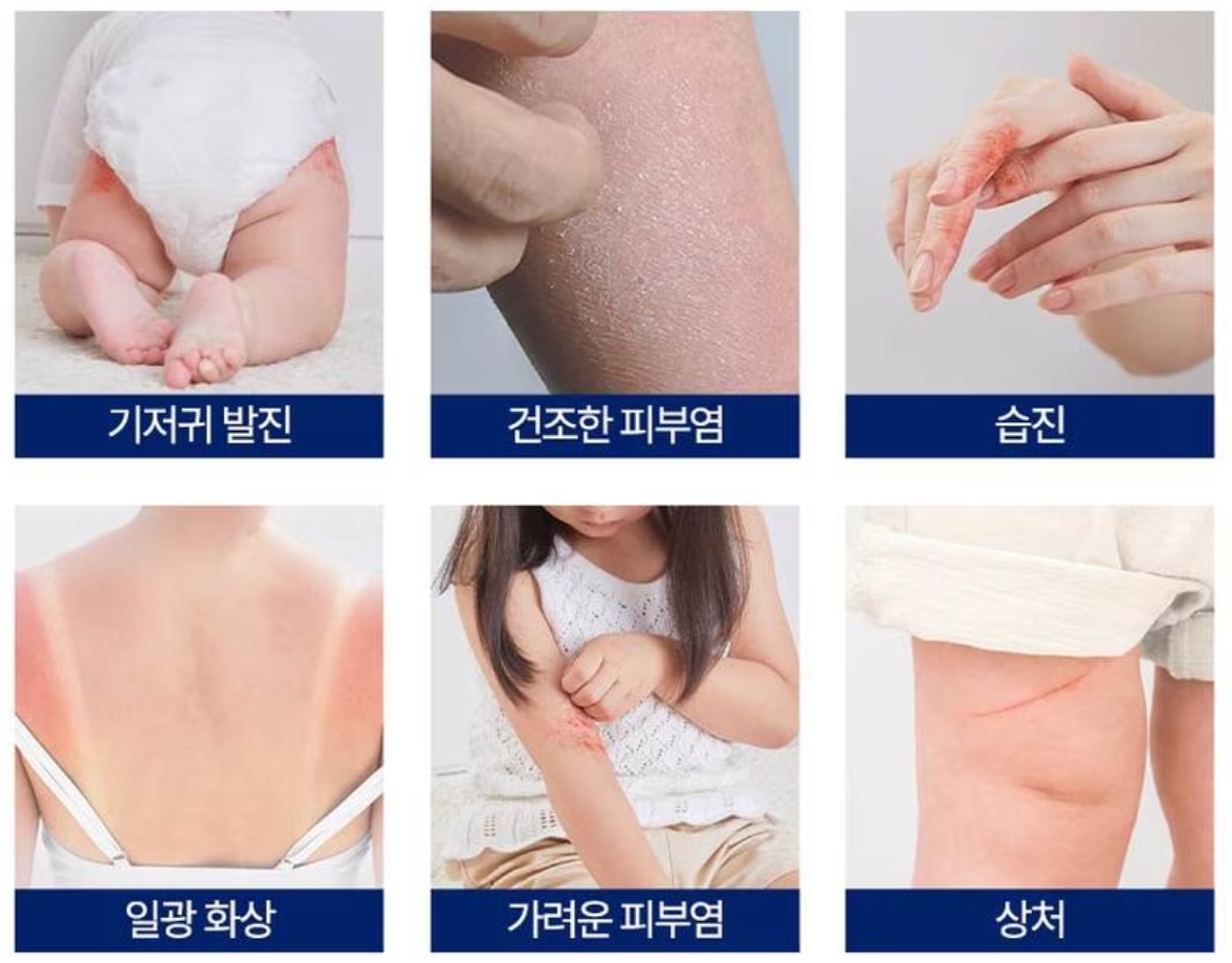 비판텐 연고 효과 관련 사진