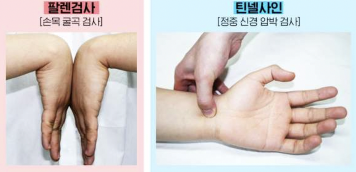손목 터널 증후군 자가 진단 방법