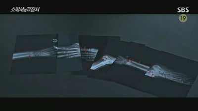 피해자 아이 몸에 있던 여러개의 골절 부위 엑스레이 사진입니다.