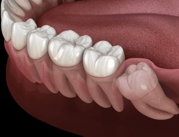 사랑니 발치 전 주의사항, 알아야 할 6가지 필수 사항