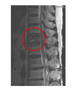 척추성형술 시술 전