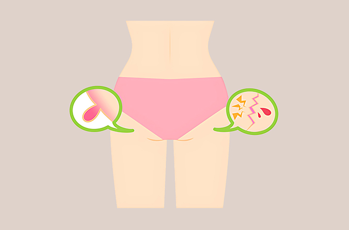 치질에-걸린-여성