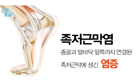 족저근막염2