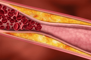 고지혈증에 좋은 음식02