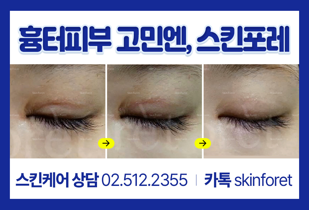 돌출눈과 함몰눈 수술 후 흉터 제거 비포 애프터