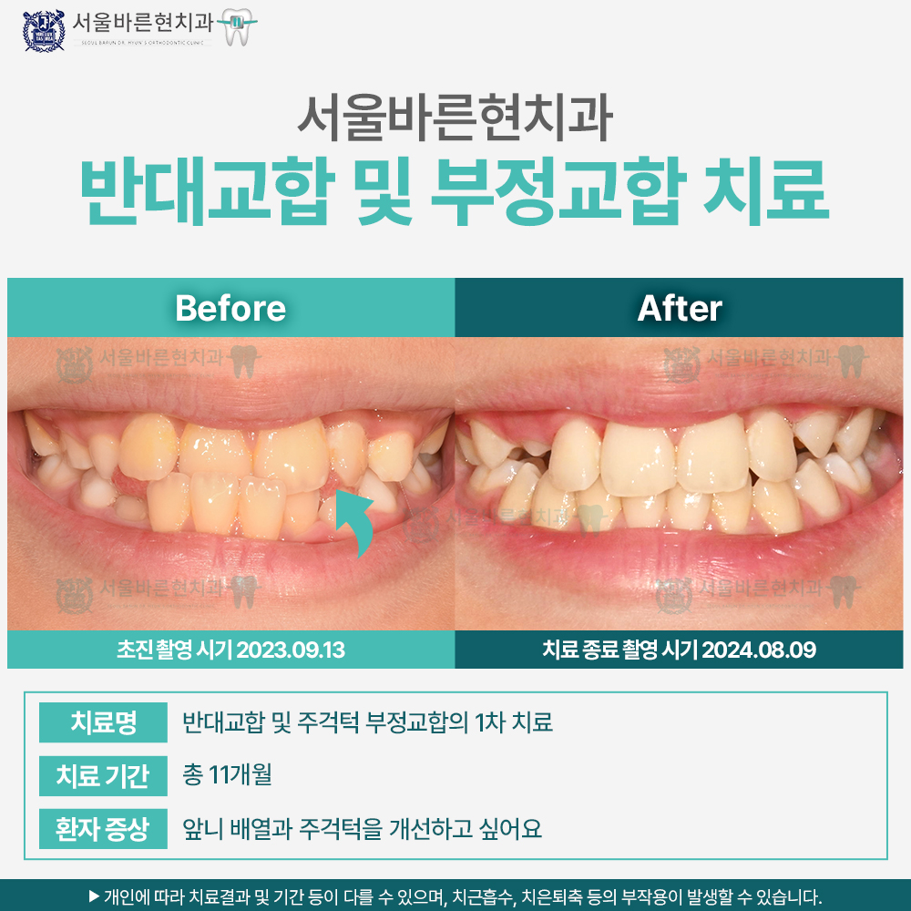 부산치아교정