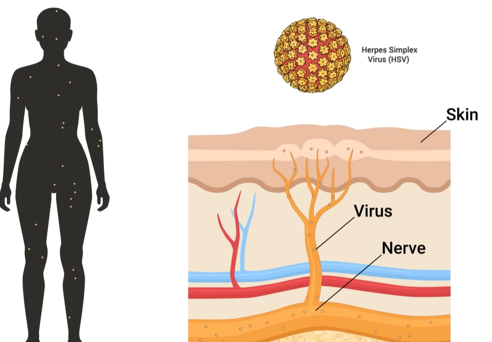 헤르페스 2형 증상