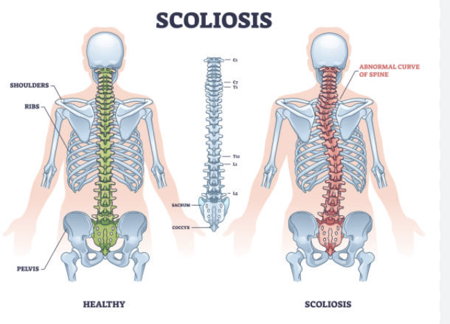 척추측만증에 대한 완전 정보와 관리 방법